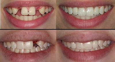 Trồng răng Implant đẹp và an toàn ở đâu?