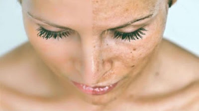Cara Menghilangkan Flek Hitam Di Wajah Serta Pipi Dan Hidung Yang Membandel Cara Menghilangkan Flek Hitam Di Wajah Serta Pipi Dan Hidung Yang Membandel