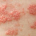 Bị sùi mào gà có chữa được không