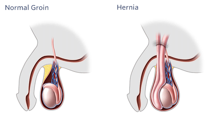 incarcerated hernia