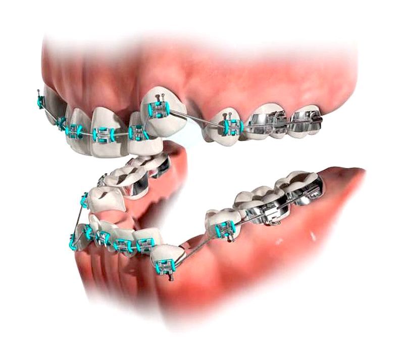 PDF Frequency of orthodontic extraction