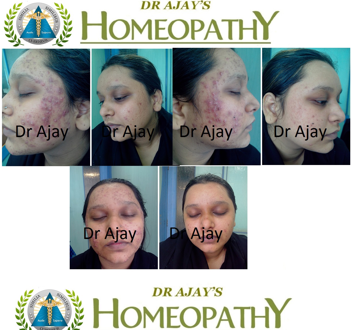Dr Ajays Homeopathy Homeopathy For Acne & Acne Scars