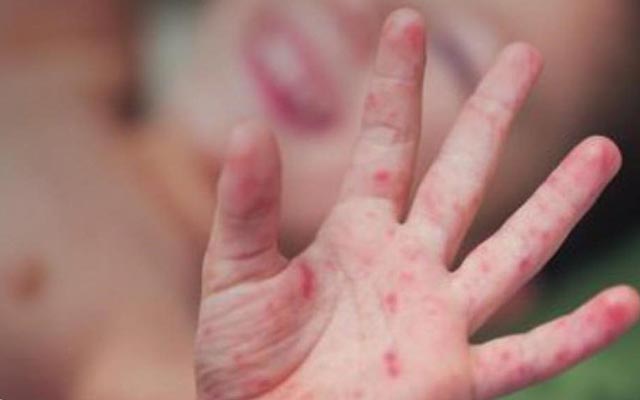 Doença conhecida como 'mão-pé-boca' atinge 50 crianças em Salvador e recôncavo