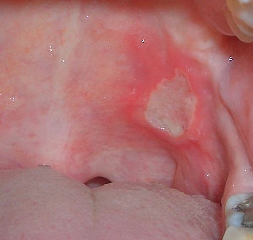 Oral Throat 35
