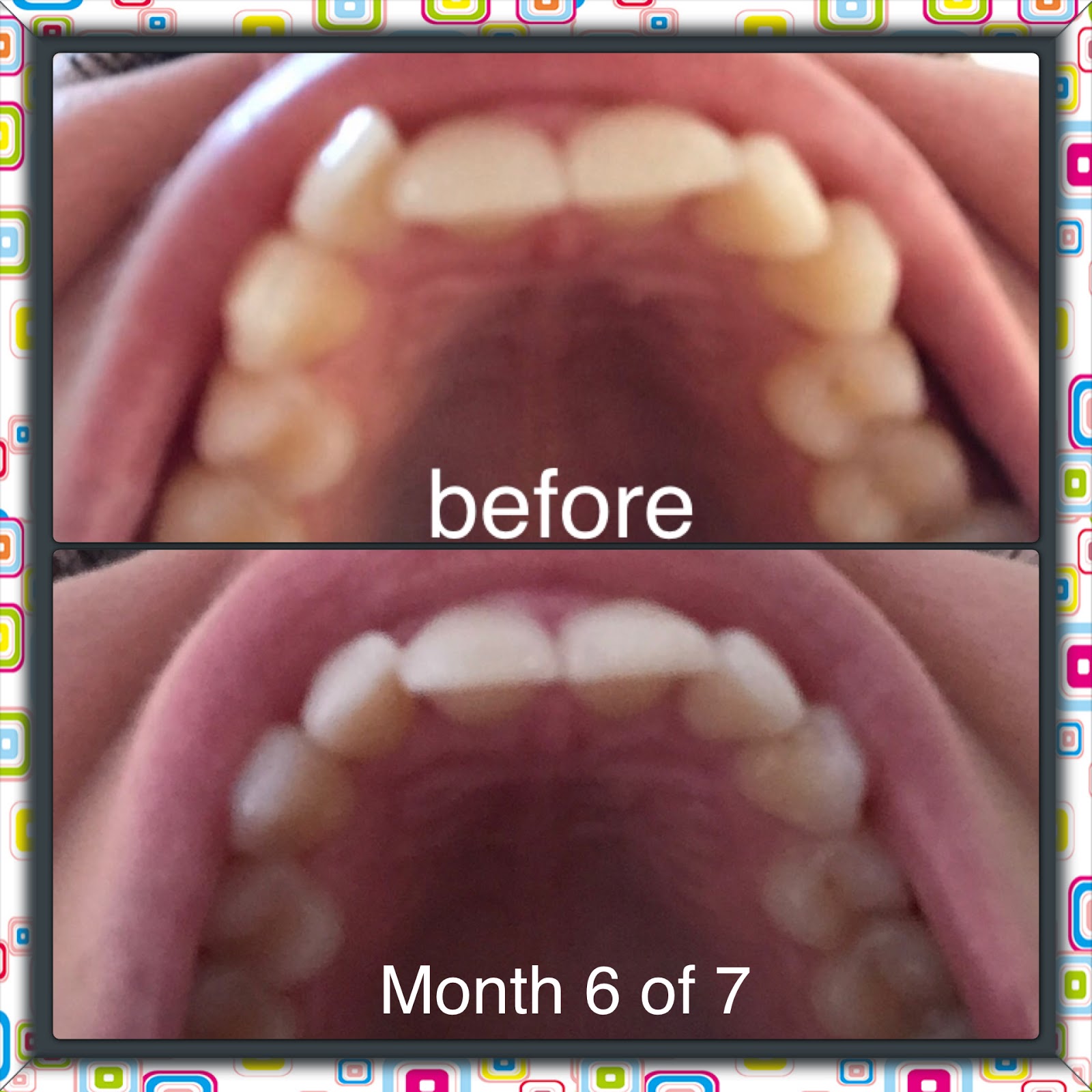 20 Off Voucher Code Smile Direct Club 2020 The Beauty Of Smiles