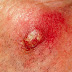 Treatments of Boil - Get Rid of Boils Permanently