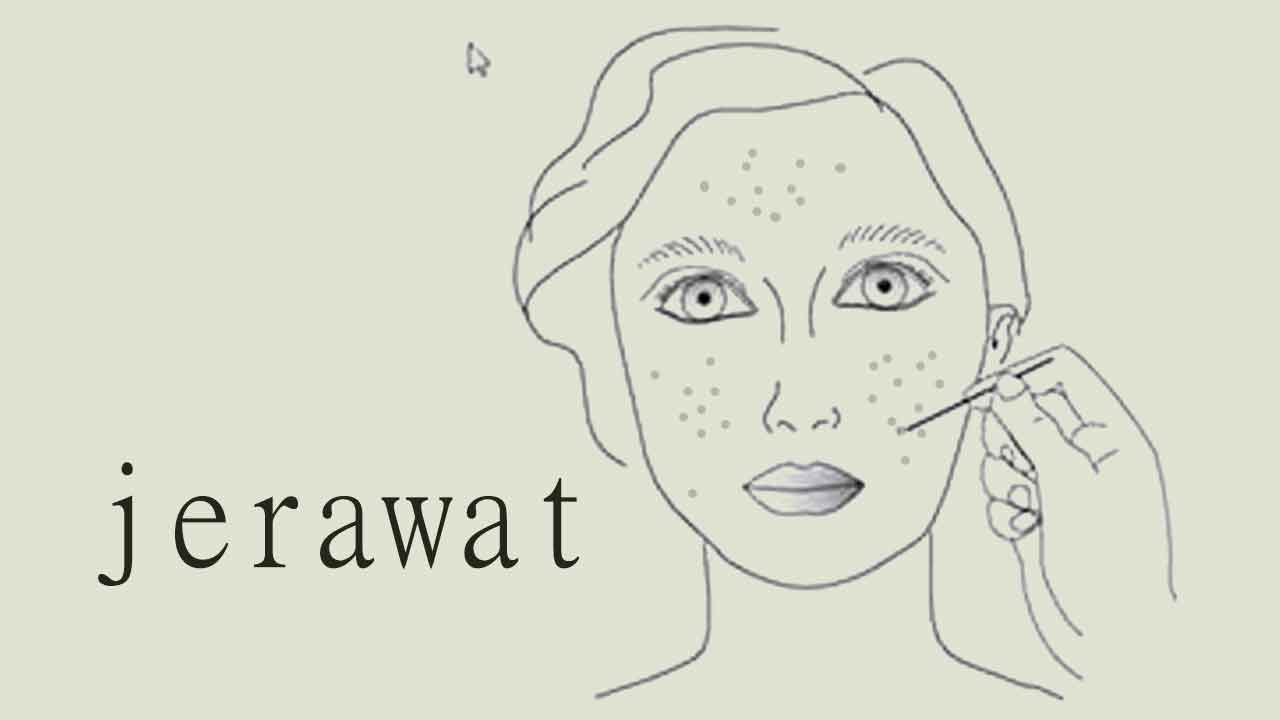 6-obat-alami-atasi-jerawat 6-obat-alami-atasi-jerawat