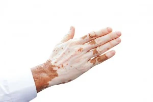 dieta sin gluten ayuda con el vitiligo