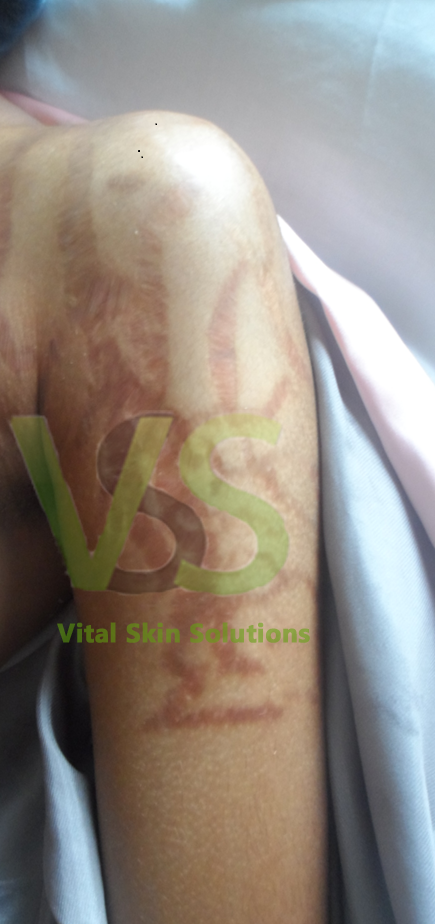 bleaching cream for stretch marks