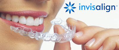 khay-nieng-rang-Invisalign