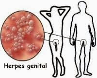Jual Obat Herpes Genital pada Pria dan Wanita