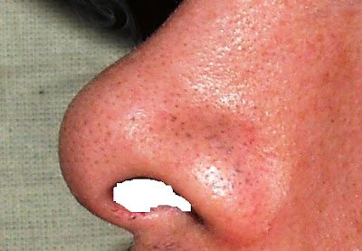 menghilangkan komedo, Cara menghilangkan komedo, tips menghilangkan komedo