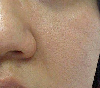 how to reduce large open pores on face in urdu