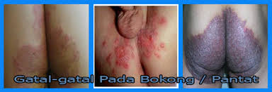 obat eksim kering pada kulit pantat