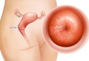 Erosi Serviks, Kedua Tuba Non Paten Dipangkal Dan Retrofeksi Sembuh Erosi Serviks, Kedua Tuba Non Paten Dipangkal Dan Retrofeksi Sembuh