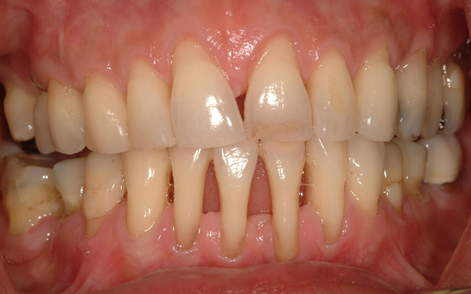 Study Medical Photos Disorders Of The Gum