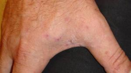 Τί είναι η ψώρα