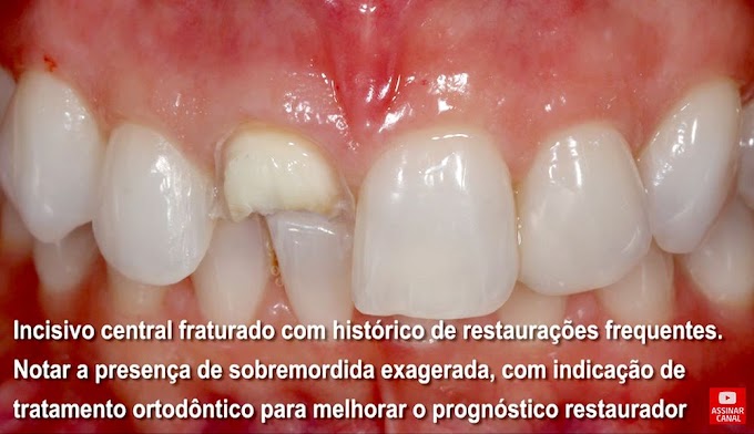 DENTÍSTICA: Reconstrução e Reanatomizações em Dentes Anteriores