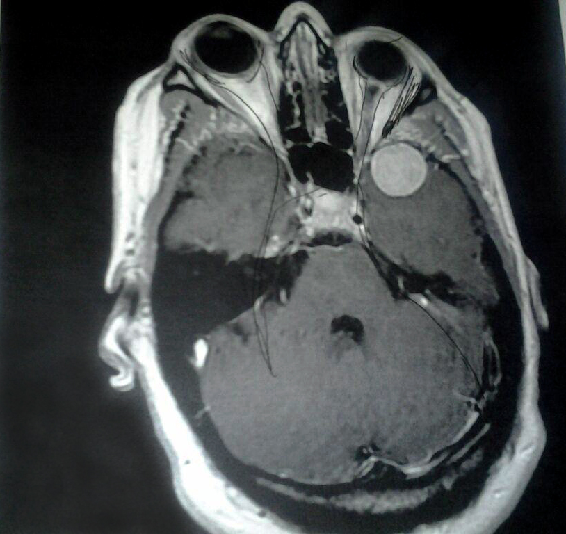 Tumor Tumor Behind Eye