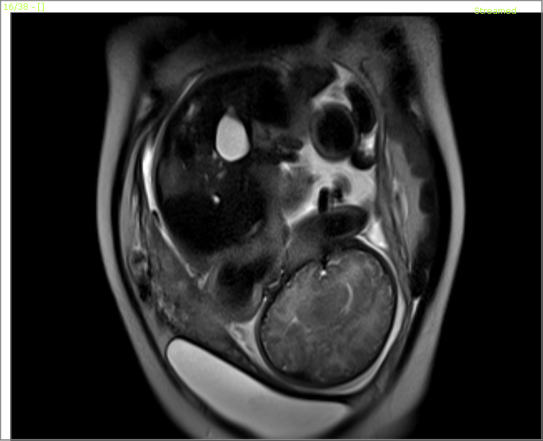 My Radiology World: Placenta previa..