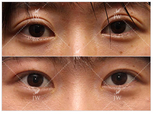 double eyelid disappear