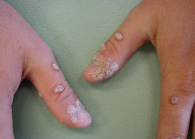 What is Periungual Warts - Definition, Symptoms, Causes, Treatment