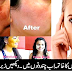 Remedies to Get Rid of Face Freckles Naturally