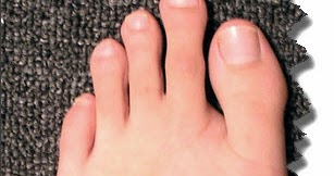 GaryMoller.com - Health, Fitness - Naturally!: I have Morton's Foot and ...