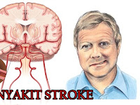 Terapi Untuk Mengobati Penyakit Stroke Secara Alami Terapi Untuk Mengobati Penyakit Stroke Secara Alami