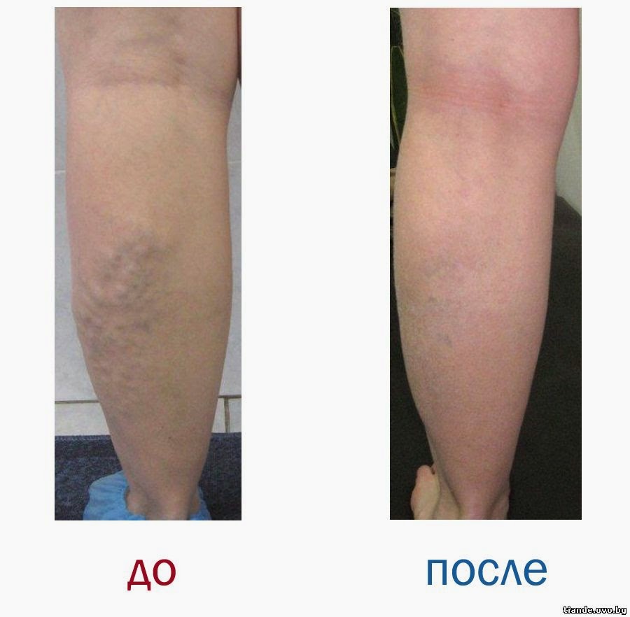 ТианДе - Небесно съвършенство!: Славитон - при умора и тежeст в краката