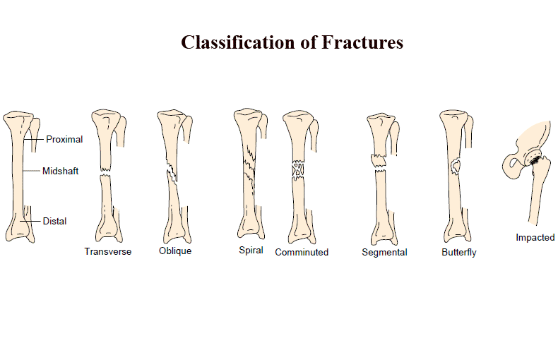 Nursing Care Plan for Bone Fractures ~ Lifenurses