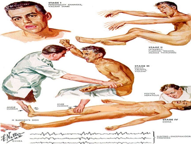hepatic-encephalopathy-14-638