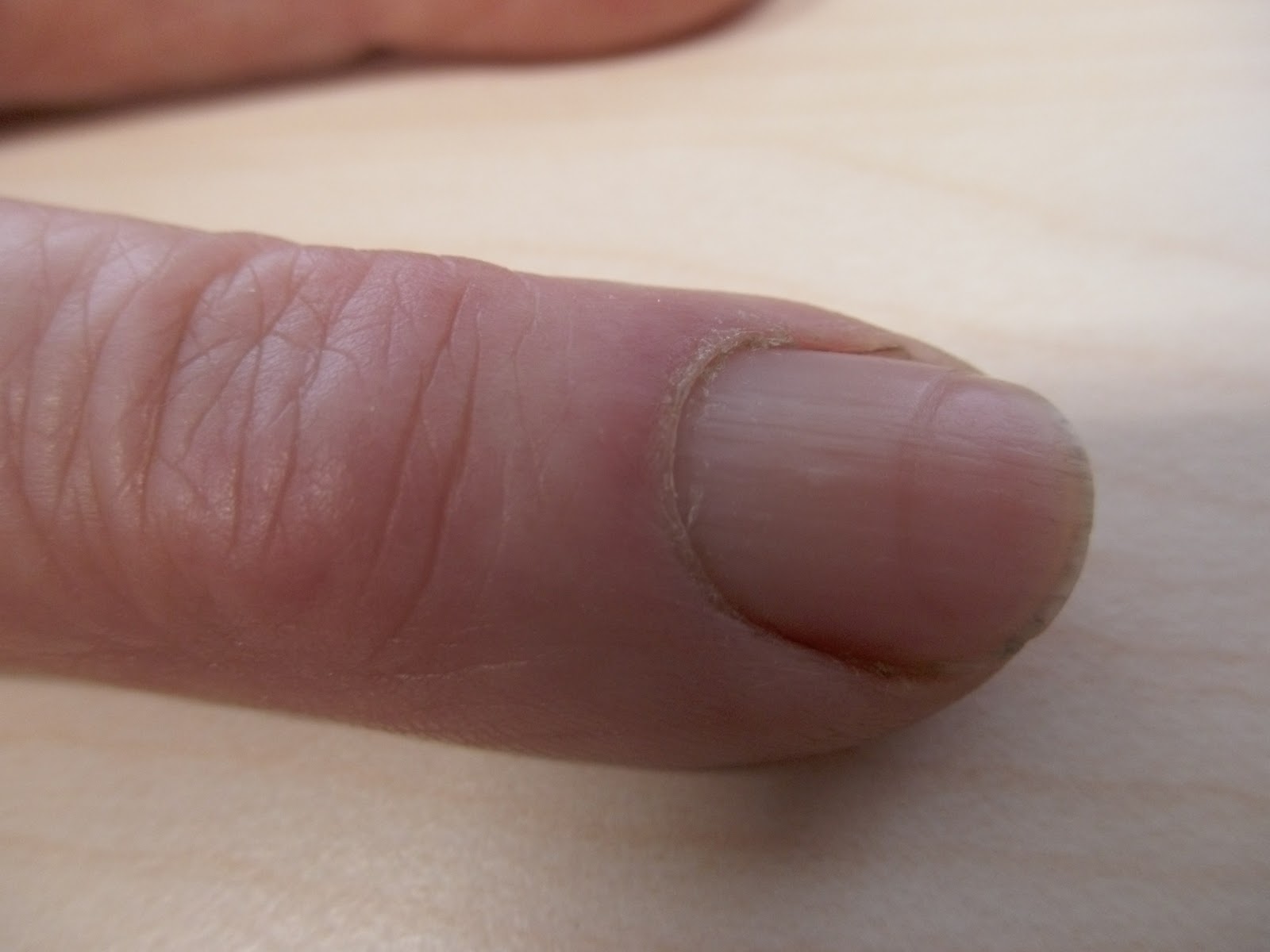Rheumatologe Trophic disturbance in nail growth