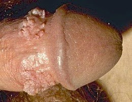 obat kutil kelamin paling murah