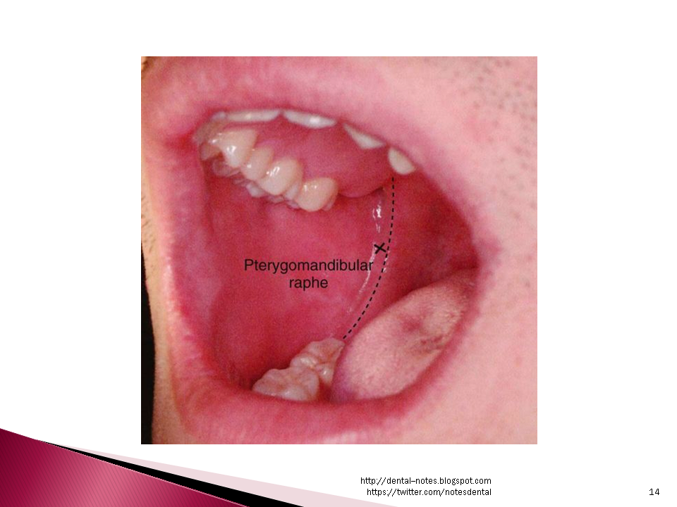 Dental Notes Inferior Alveolar Nerve Block NOTES