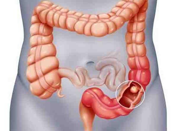 Early Signs Of Colon Cancer Early Signs Of Colon Cancer