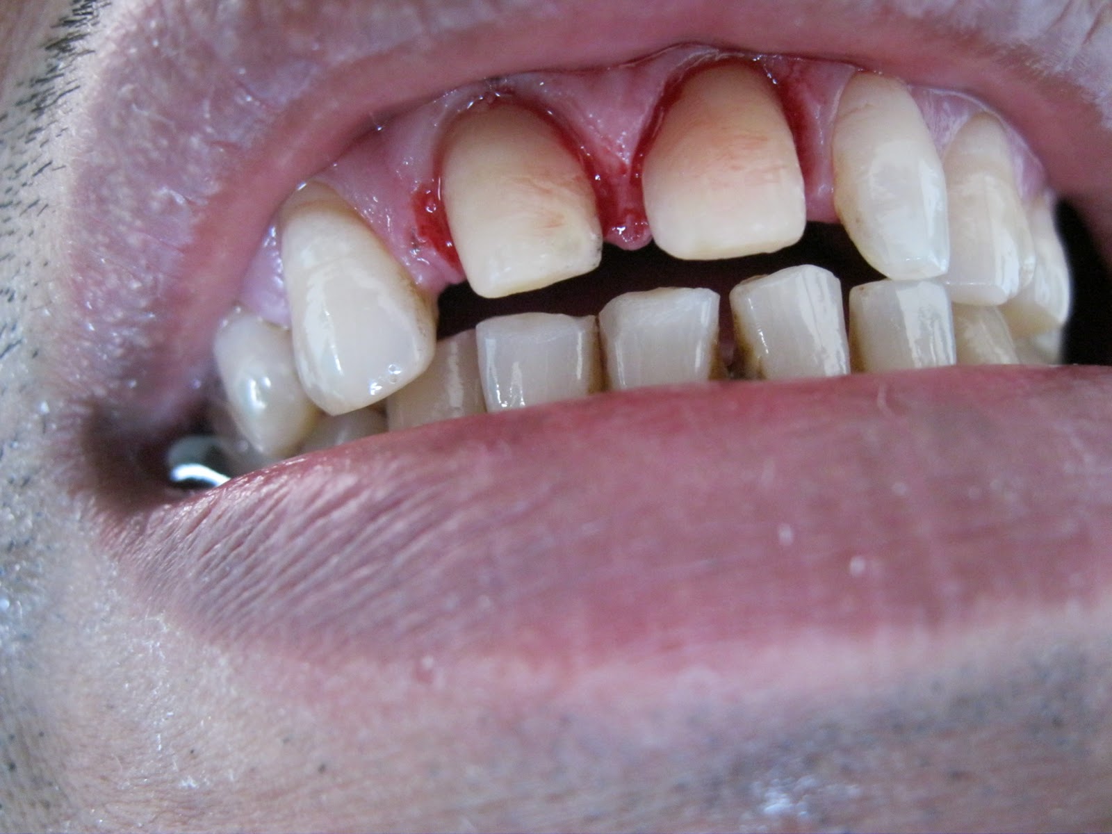 DENTO CARE DENTAL CLINICS CROWN AND BRIDGEIPS EMAX