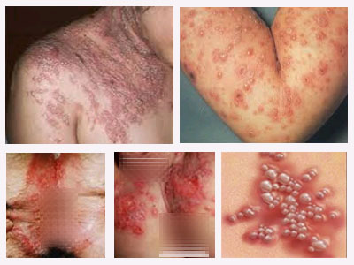 Penyakit Herpes Berbahaya dan Sangat Menular