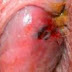 Obat Generik Ambeien Luar thumbnail