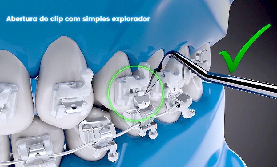 ORTODONTIA Bráquete Ceramic SLI Aparelho Autoligado Estético Morelli