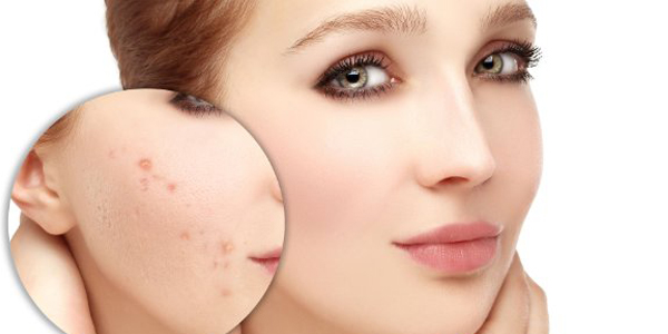 Cara Menghilangkan Bekas Jerawat Secara Alami Menggunakan 7 Bahan Ampuh Ini