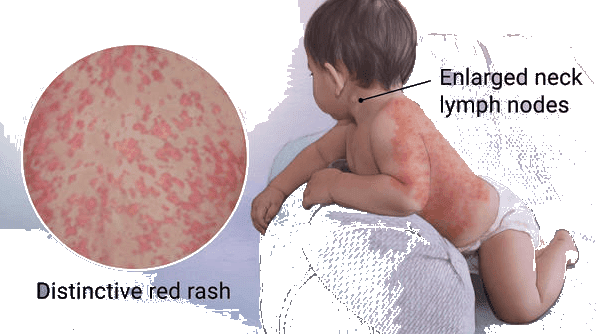 Image-of-Rubella