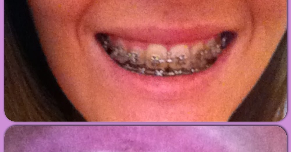 A Guide to Surviving Orthognathic Surgery Cleaning your Braces