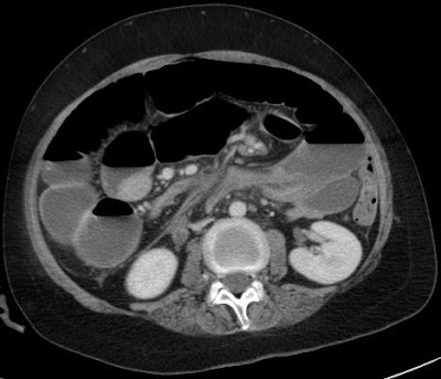 Organoaxial cecal volvulus