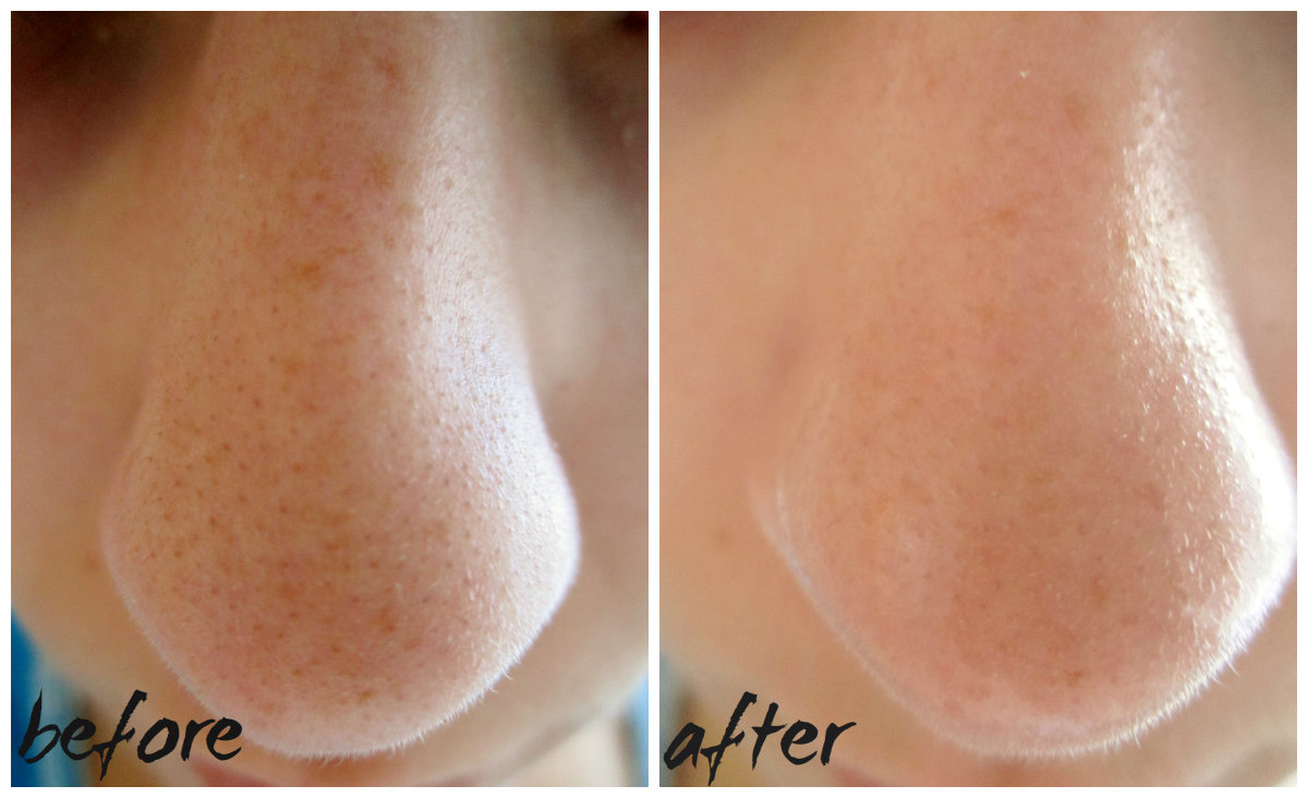 Закрытые поры на лице как. Закрытые поры на лице как. Закрытые поры на лице как. Закрытые поры на лице как. Закрытые поры на лице как.