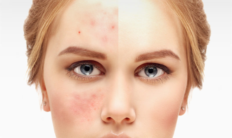 Dieta keto y acne