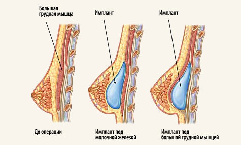 увеличение груди doctorvis.ru