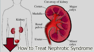 How to Treat Nephrotic Syndrome How to Treat Nephrotic Syndrome