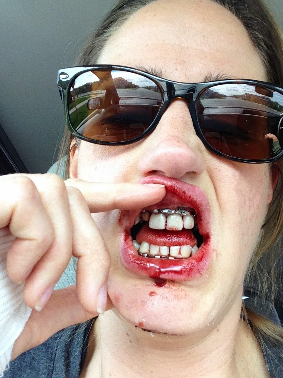 My Broken Jaw Trauma: October 2014