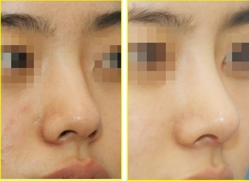 Khi nào mới nên phẫu thuật trị vẹo vách ngăn mũi?